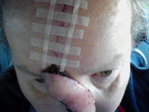 Removal of forehead stitches, roughly 4 weeks after reconstruction.